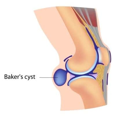 Bakers Cyst Of The Knee