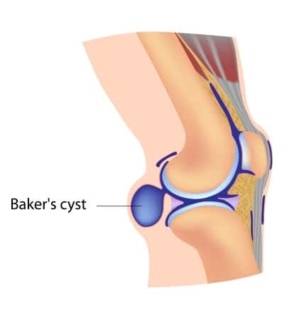 bakers cyst pain behind the knee
