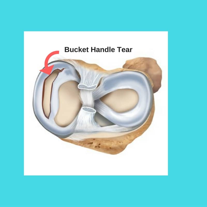 medial meniscus tear