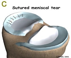 bucket handle meniscus tear repair