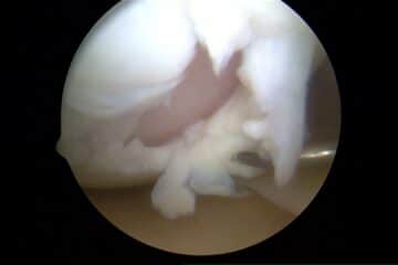 cartilage loss and microfracture