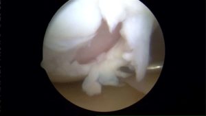 knee cartilage injury