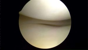 normal knee cartilage
