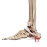 foot stress fracture calcaneus
