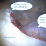 rotator cuff tear pain when lifting the arm