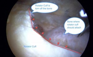 Can rotator cuff tear become larger