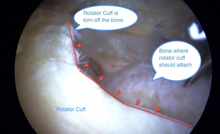 rotator cuff tear pain when lifting the arm