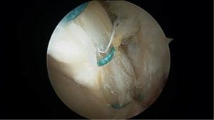 Hip Pain Labral Repair