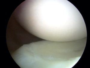 Normal Articular Cartilage