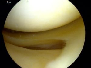 Meniscus Tears : What does a normal meniscus look like