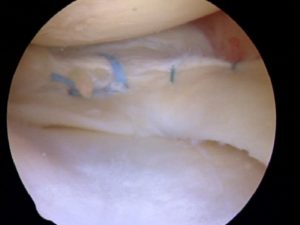 meniscus tear repair in children