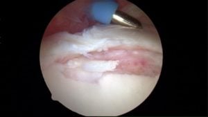 Shoulder Dislocation - Labral Tear