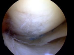 Osteoarthritis of the knee