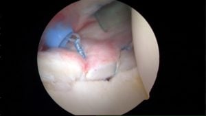 Shoulder Dislocation - Labral Repair