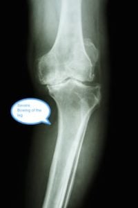 knee replacement alternatives 