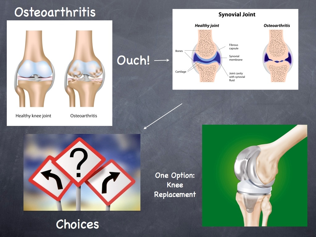 Arthritis Treatment Options