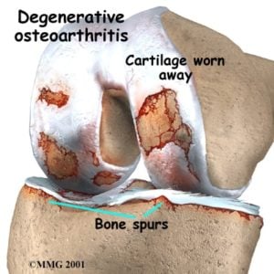 ACL arthritis knee