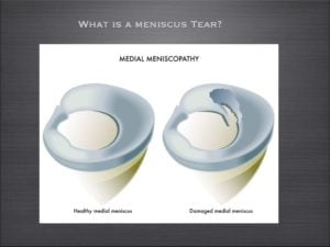 degenerative meniscus tear