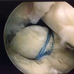 meniscus tear pain back of knee