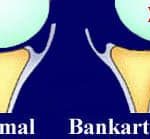 dislocated shoulder bankart