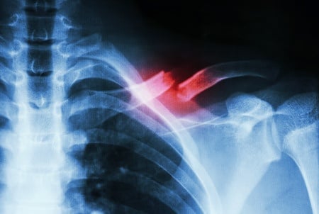 broken-collar-bone.jpg