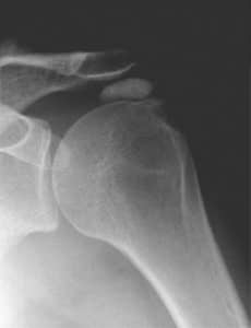 What is calcific tendonitis of the shoulder?