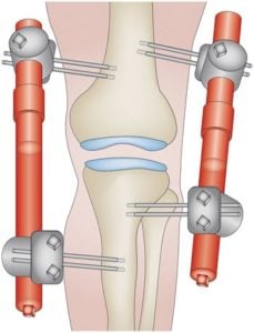 knee distraction knee replacement alternative