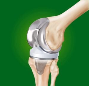 Knee Replacement 