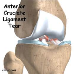 ACL Tear _ Knee_ Howard Luks- Westchester County, NY