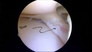 Posterior Horn Meniscus Tear