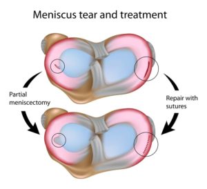 meniscus tear and golf