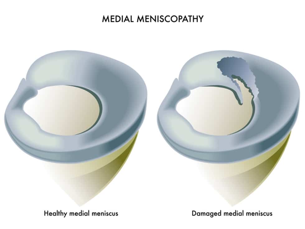 medial meniscus tear