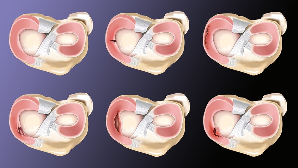 Meniscus tears 