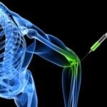 PRP Injection Tennis Elbow