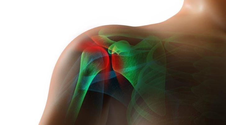 Rotator Cuff Tears