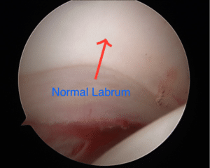 Hip posterior labrum