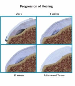 Partial Thickness Rotator Cuff Tear