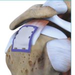partial rotator cuff tear repair