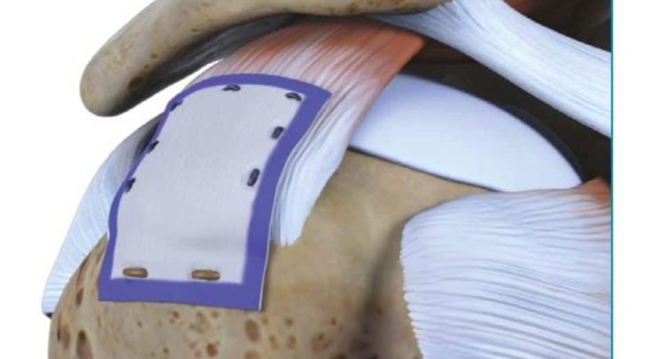 partial rotator cuff tear repair