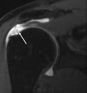 rotator cuff tear, westchester county, ny 