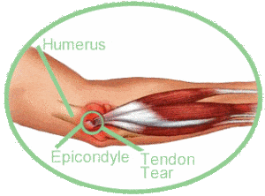 Tennis Elbow and Cortisone Injections