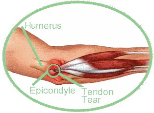 Corticosteroid injection for tennis elbow