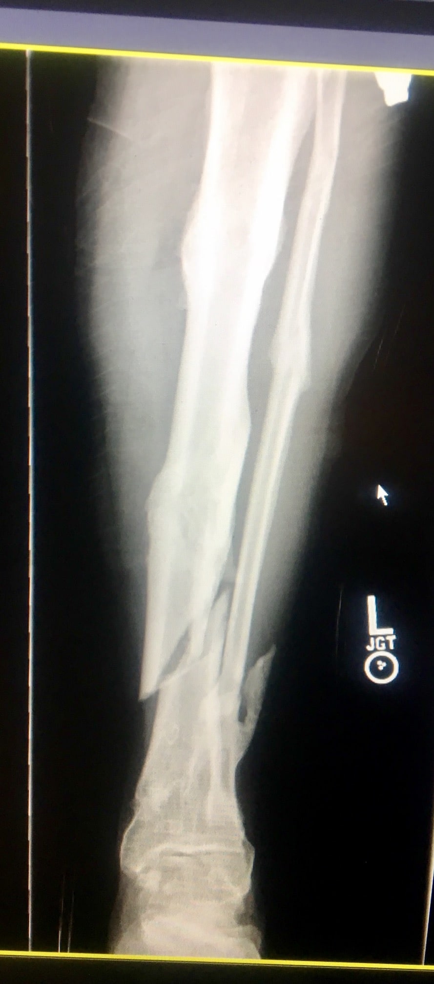 Tibia fracture in athletes – Howard J. Luks, MD