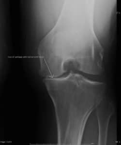 knee arthritis knee replacement alternative