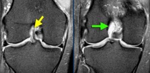 partial ACL tear Howard Luks Westchester County, NY