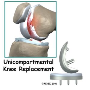 partial knee replacement