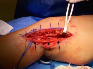 peroneal nerve surgery for leg pain