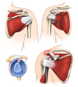 Do I have a full thickness rotator cuff tear