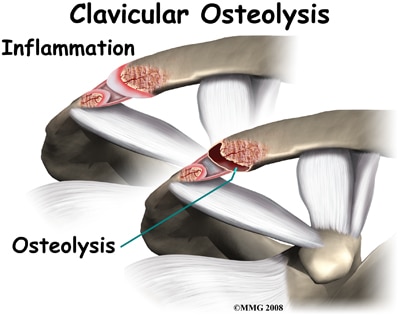 clavicularis osteoarthritis