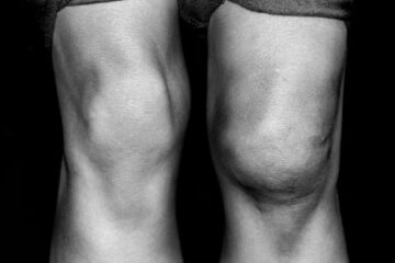 swollen knee serious knee injury